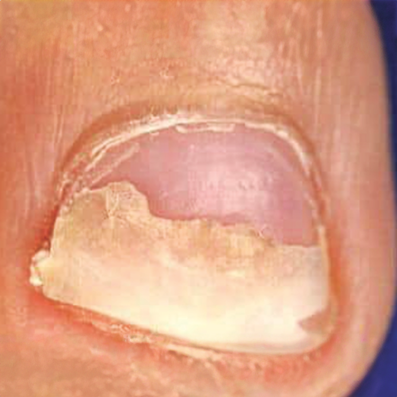 Les dangers du décollement des ongles (onycholyse) et comment l’éviter — free download